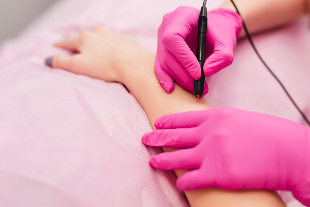 Electrolysis Hair Removal
